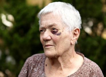 An elderly woman with a black eye